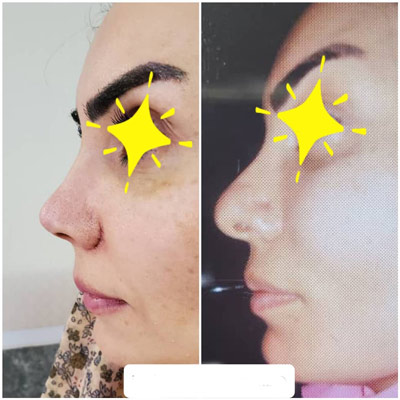 نمونه کار جراحی بینی دکتر حسن طاهری3 نمونه کار جراحی بینی دکتر حسن طاهری3