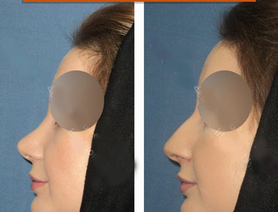نمونه کار جراحی بینی دکتر خوبهی1 نمونه کار جراحی بینی دکتر خوبهی1