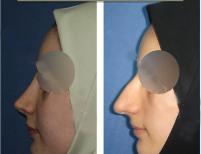 نمونه کار جراحی بینی دکتر خوبهی2 نمونه کار جراحی بینی دکتر خوبهی2