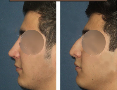 نمونه کار جراحی بینی دکتر خوبهی4 نمونه کار جراحی بینی دکتر خوبهی4