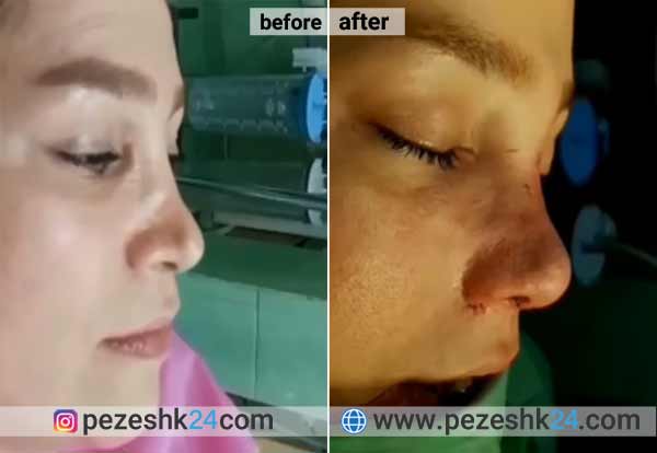 نمونه جراحی ترمیم بینی دکتر مقدم نیا