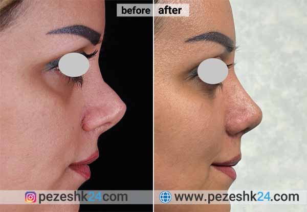 نمونه جراحی ترمیم بینی دکتر پورارز 1