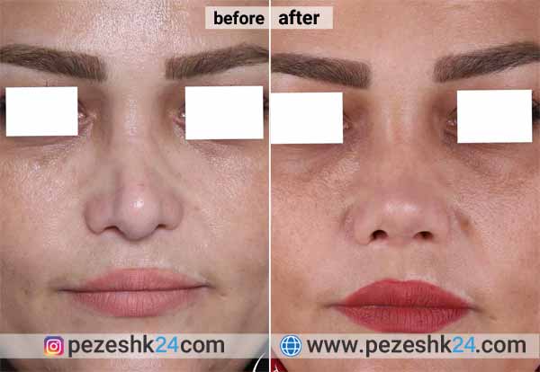 نمونه جراحی ترمیم بینی دکتر پورارز 2