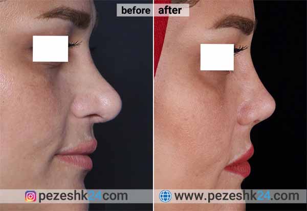 نمونه جراحی ترمیم بینی دکتر پورارز 3