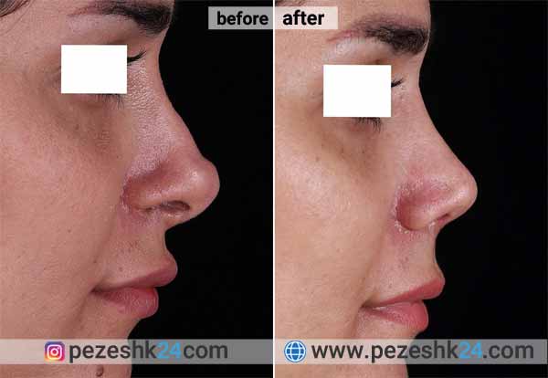 نمونه جراحی ترمیم بینی دکتر پورارز 4