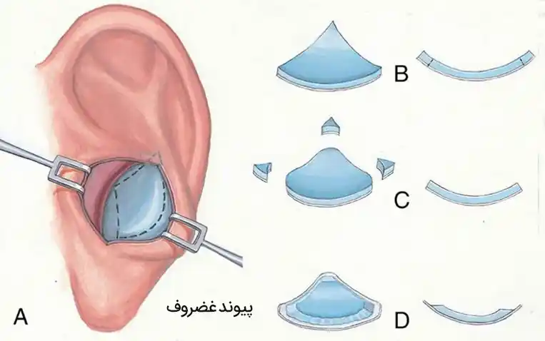 پیوند غضروف گوش برای عمل ترمیمی بینی