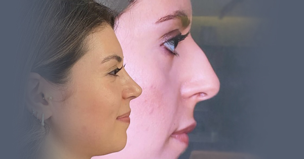 پیوند غضروف در بینی