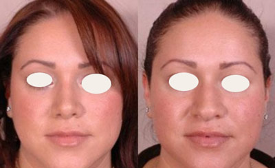 دستگاه های کوچک کننده بینی دستگاه های کوچک کننده بینی