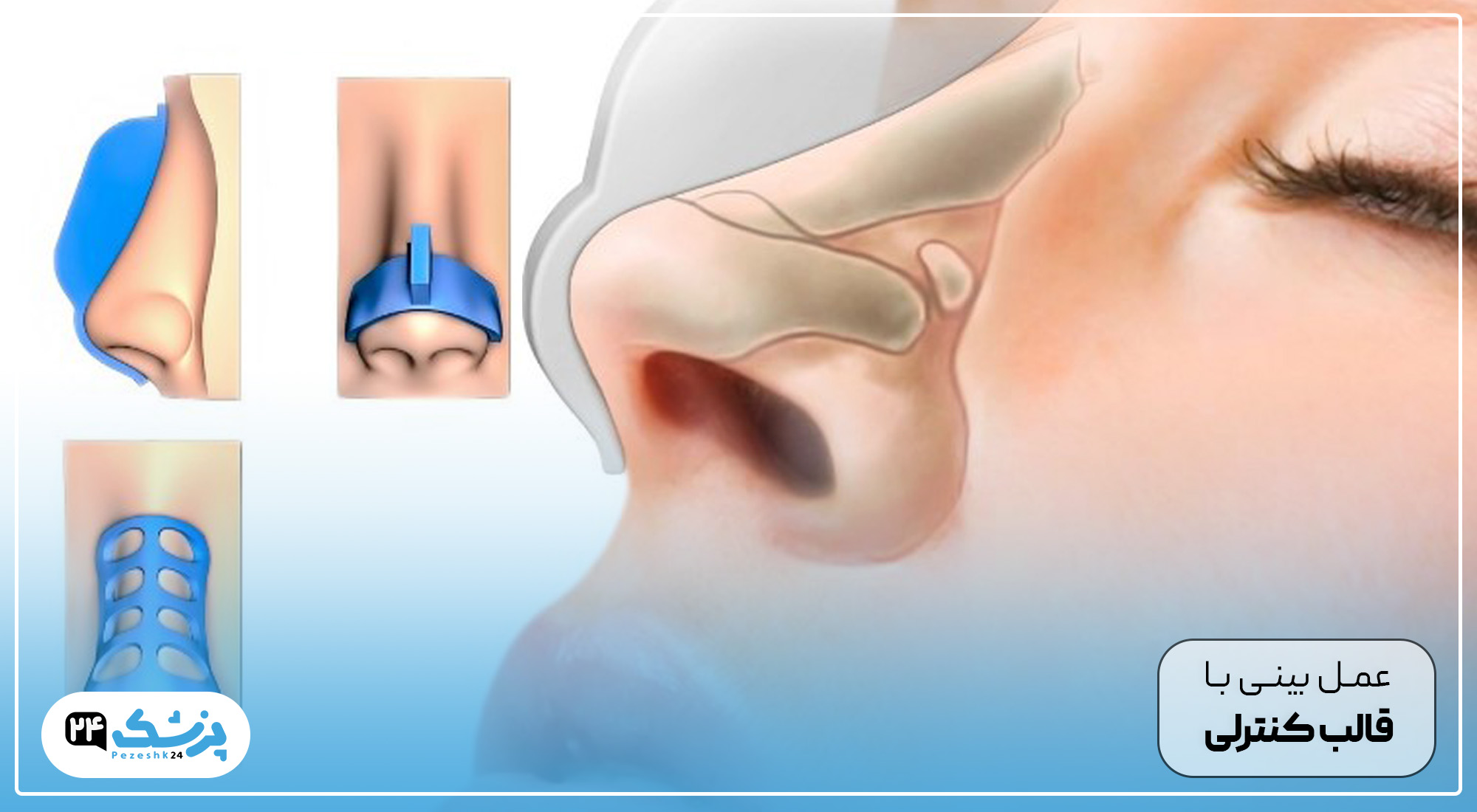 عمل بینی با قالب کنترلی