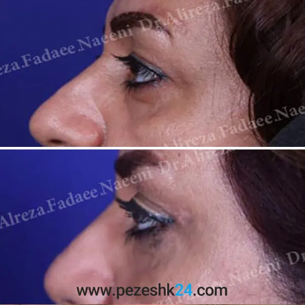 نمونه جراحی بلفاروپلاستی در رشت 2