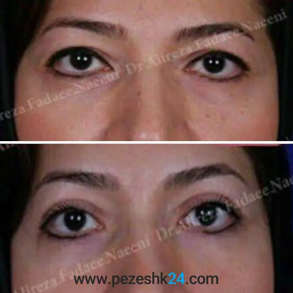 نمونه جراحی بلفاروپلاستی در رشت 1