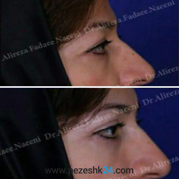 نمونه جراحی بلفاروپلاستی در رشت 5