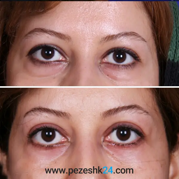 نمونه جراحی بلفاروپلاستی در رشت 3