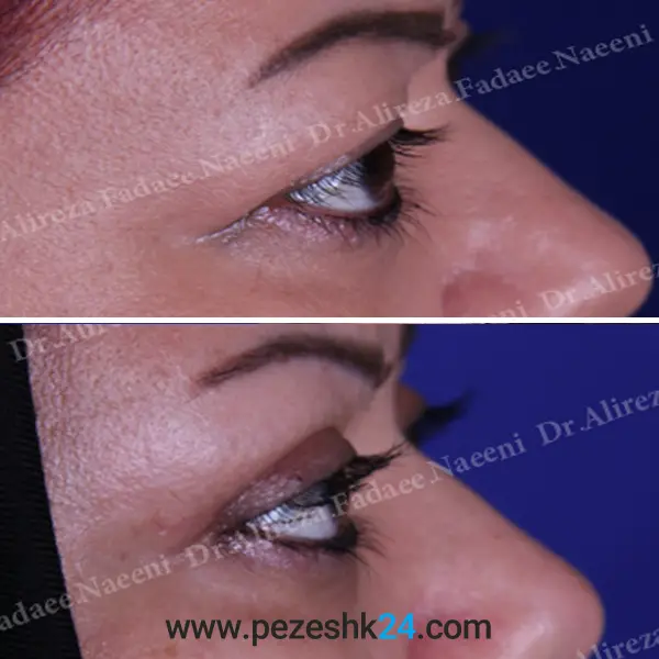 نمونه جراحی بلفاروپلاستی در رشت 4