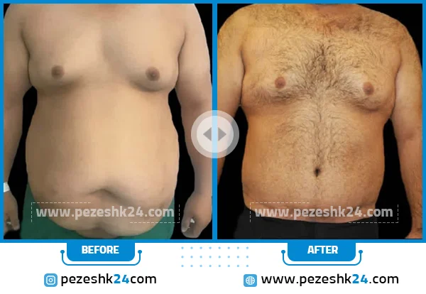 نمونه جراحی ابدومینوپلاستی دکتر غیاثی 2