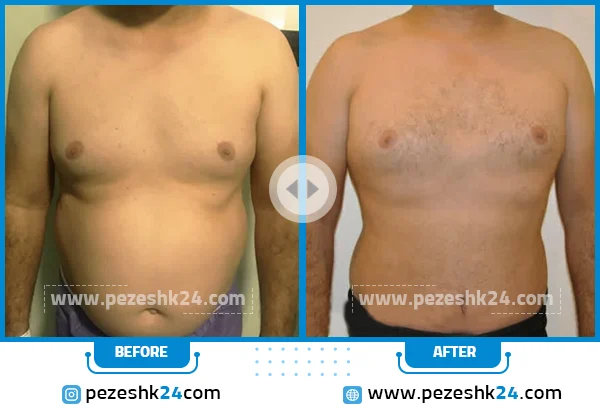 نمونه جراحی ابدومینوپلاستی دکتر غیاثی 3