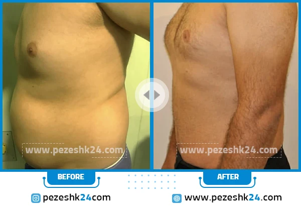 نمونه جراحی ابدومینوپلاستی دکتر غیاثی 4