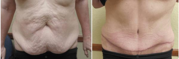 خطرات و عوارض ابدومینوپلاستی