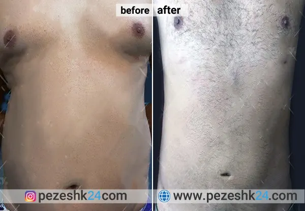 نمونه عمل لیپوساکشن دکتر علیزاده 1