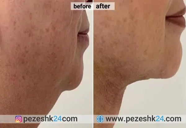 نمونه عمل لیپوساکشن دکتر علیزاده 2