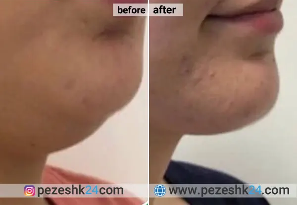 نمونه عمل لیپوساکشن دکتر علیزاده 3