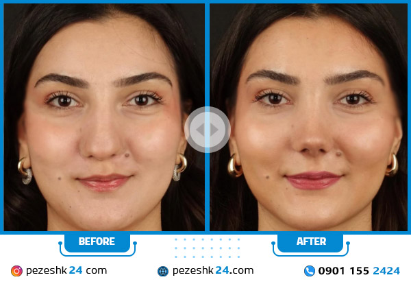 تاثیر عمل بینی برگونه ها