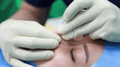 لیفت بینی در مشهد