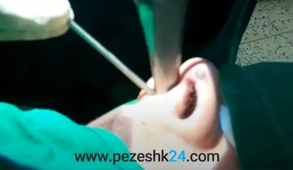 جراحی بینی با لیزر در مشهد