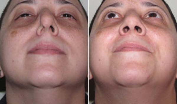 دلایل ترمیم بینی عمل شده در شیراز