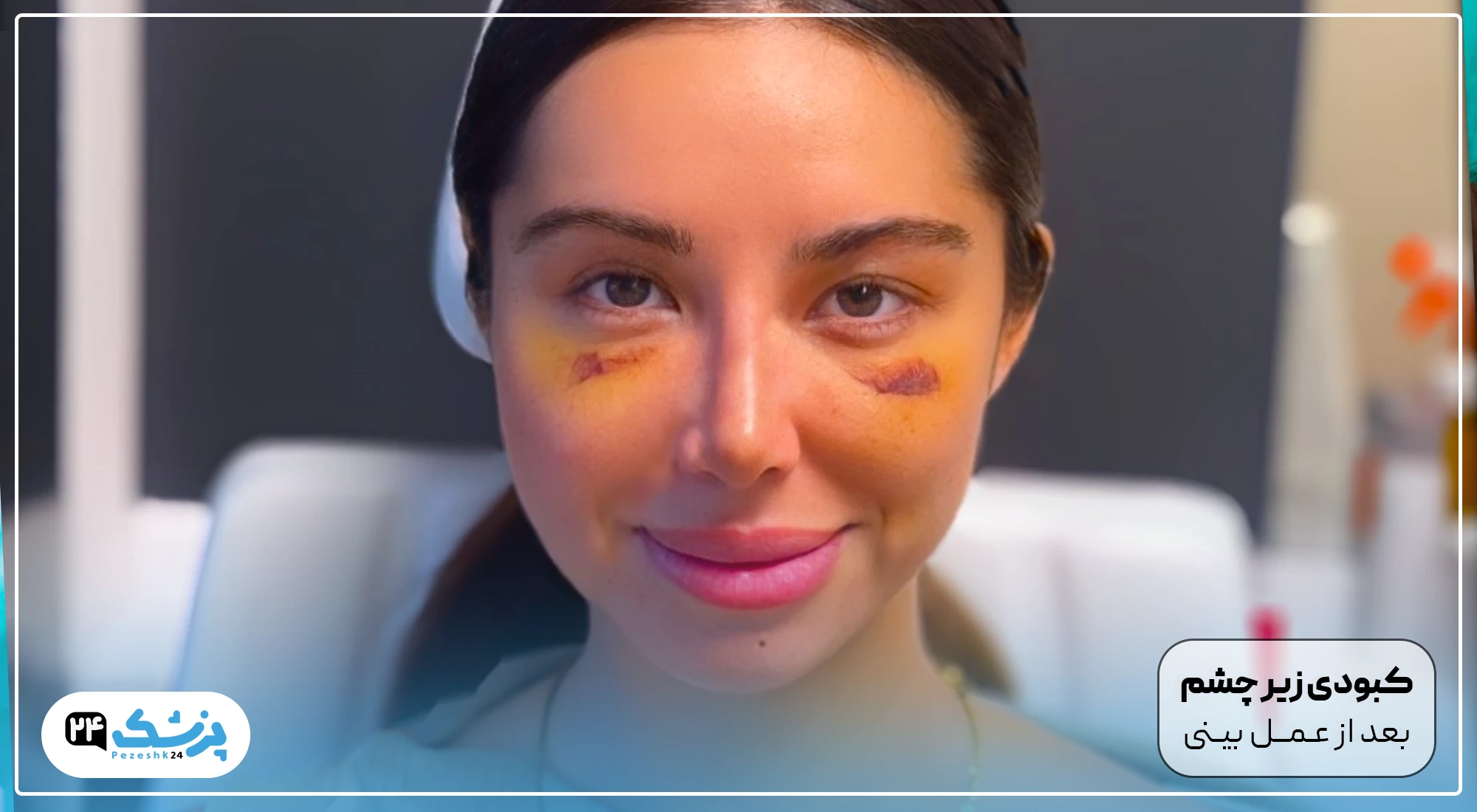 کبودی زیر چشم بعد از عمل بینی