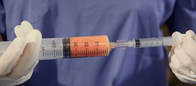 عوارض بعد از جراحی لیفت باسن برزیلی