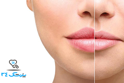 کاندید مناسب جراحی لیفت لب