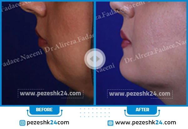 نمونه جراحی چانه دکتر فدائی 1