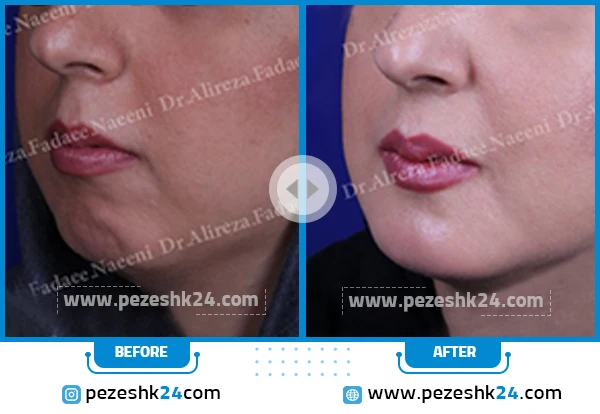 نمونه جراحی چانه دکتر فدائی 2