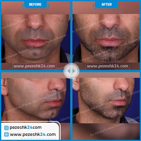 نمونه جراحی چانه دکتر فدائی 3