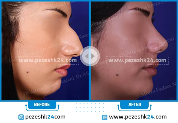 نمونه جراحی چانه دکتر فدائی 4