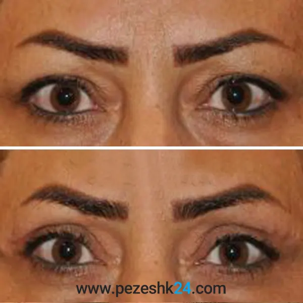 نمونه عمل بلفاروپلاستی دکتر غیاثی 1