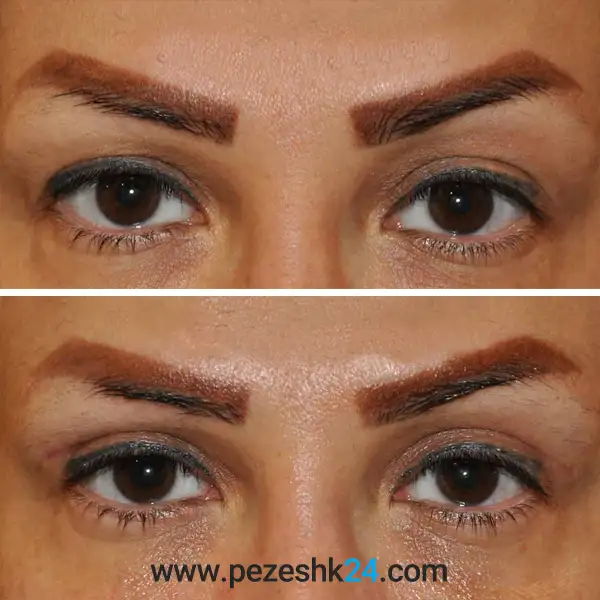 نمونه عمل بلفاروپلاستی دکتر غیاثی 2