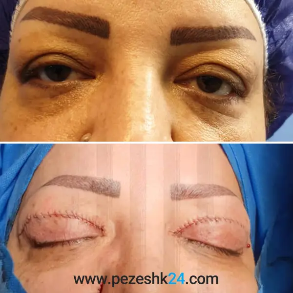 نمونه عمل بلفاروپلاستی دکتر شریفی 1