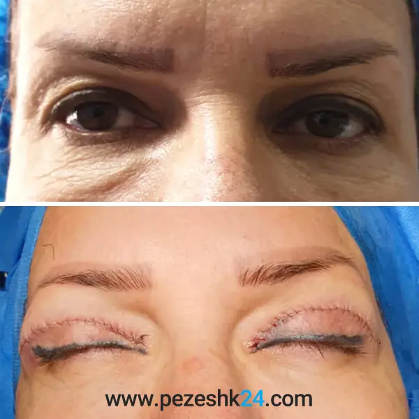 نمونه عمل بلفاروپلاستی دکتر شریفی 2