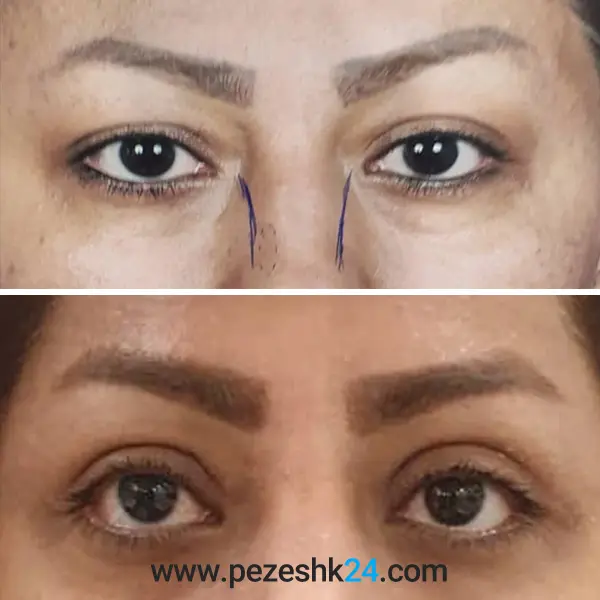 نمونه عمل بلفاروپلاستی دکتر شریفی 3