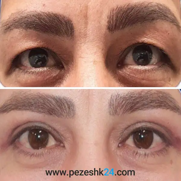 نمونه عمل بلفاروپلاستی دکتر سهراب پور 1