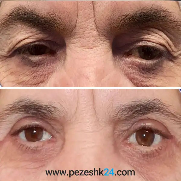 نمونه عمل بلفاروپلاستی دکتر سهراب پور 2