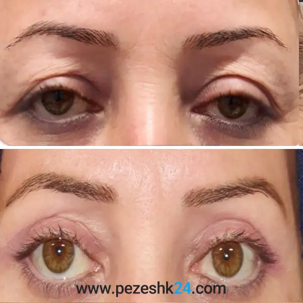 نمونه عمل بلفاروپلاستی دکتر سهراب پور 3