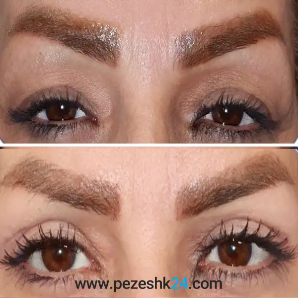 نمونه عمل بلفاروپلاستی دکتر سهراب پور 4