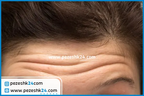 هزینه لیفت ابرو و پیشانی در مشهد