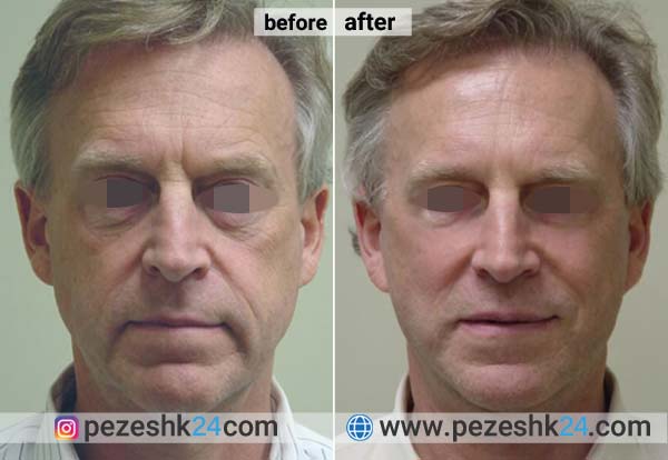 هزینه لیفت صورت در کرمانشاه