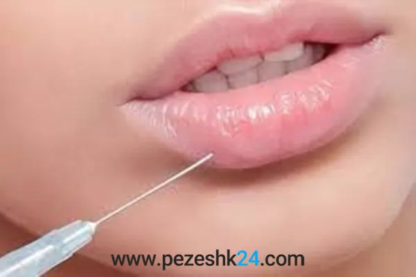 لیفت لب بدون جراحی در مشهد