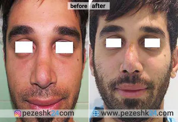 نمونه جراحی کاشت گونه دکتر نداف کرمانی 1