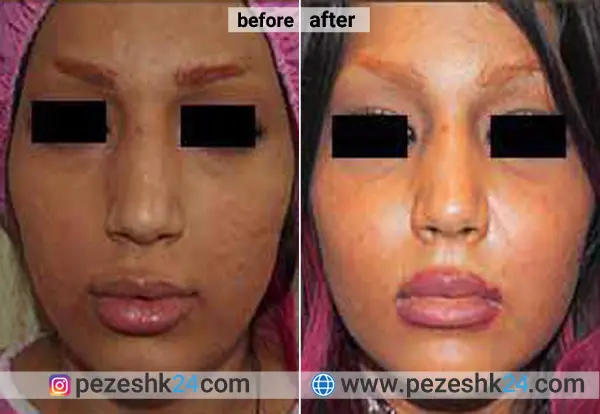 نمونه جراحی کاشت گونه دکتر نداف کرمانی 2